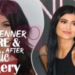 Kylie Jenner Plastic Surgery