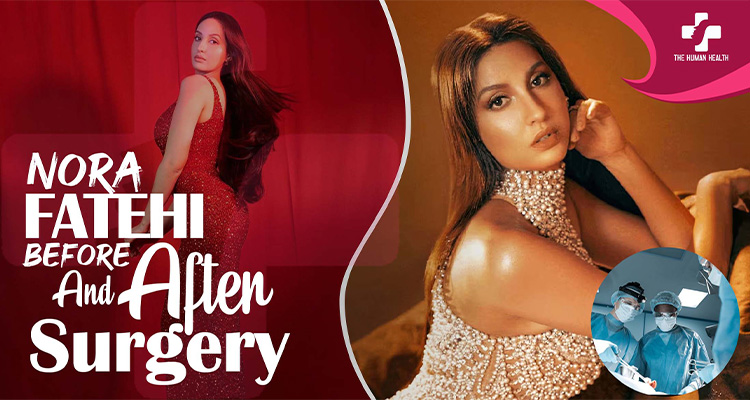 Nora Fatehi Before and After Surgery